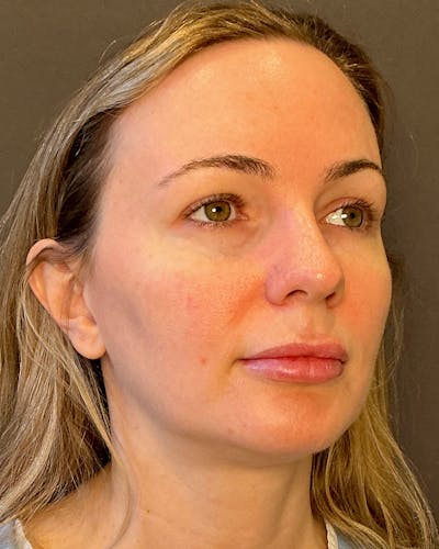 Facelifts / Necklift Before & After Gallery - Patient 252091 - Image 1