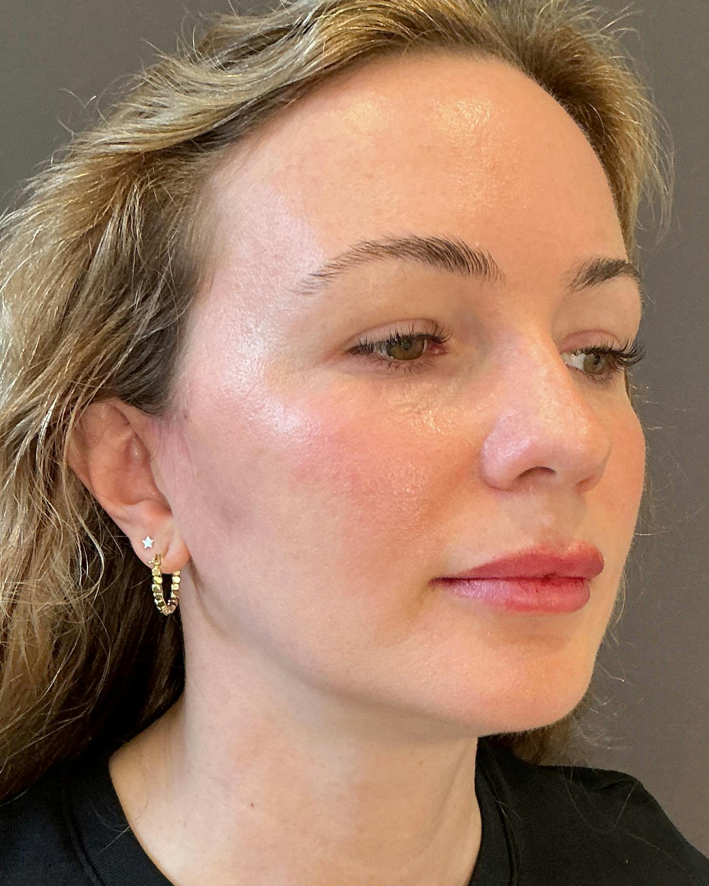 Nanolift Before & After Gallery - Patient 215709 - Image 4