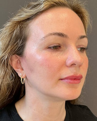 Facelifts / Necklift Before & After Gallery - Patient 252091 - Image 2