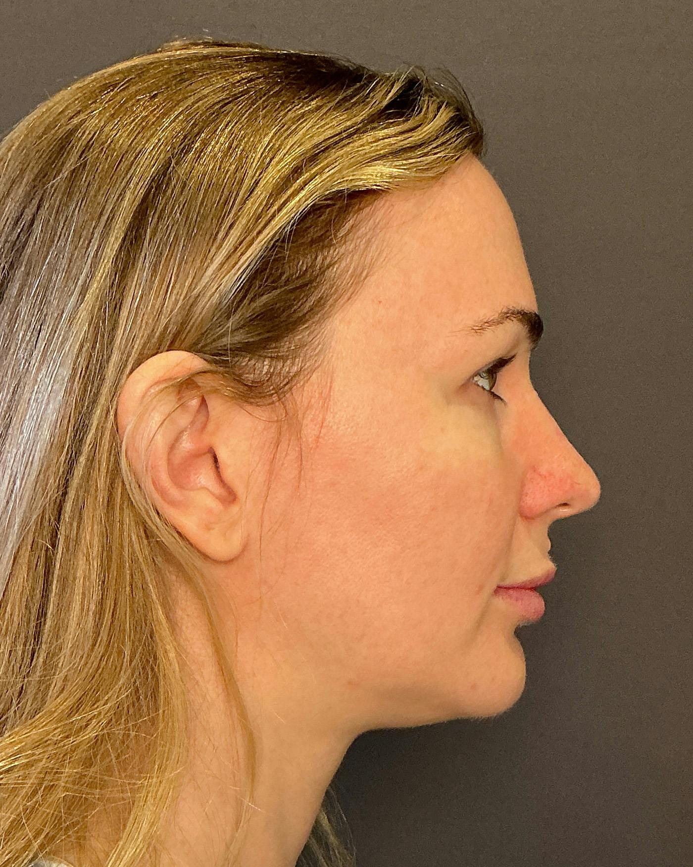 Nanolift Before & After Gallery - Patient 215709 - Image 5
