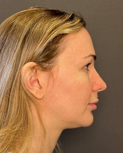 Facelifts / Necklift Before & After Gallery - Patient 252091 - Image 1