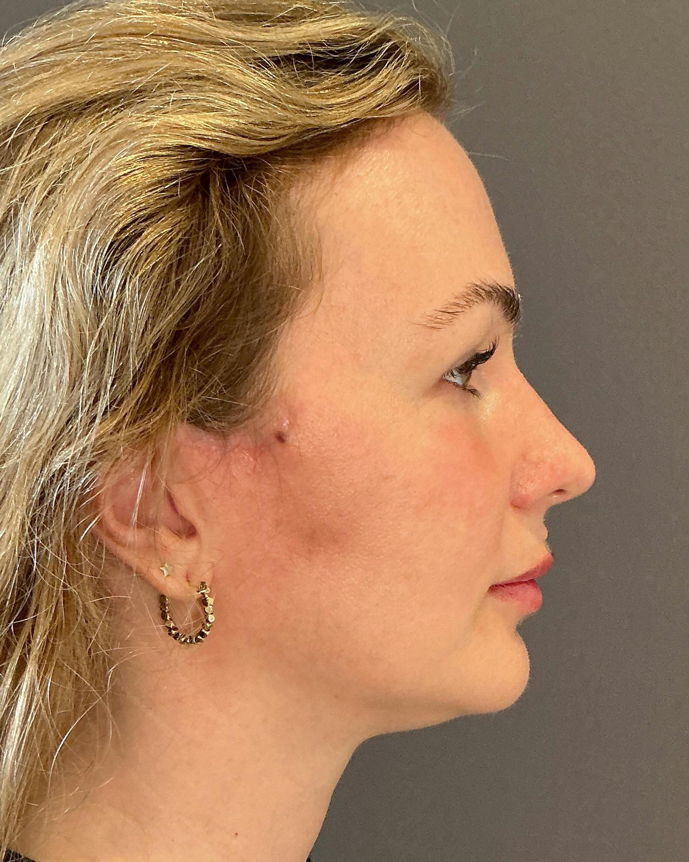 Nanolift Before & After Gallery - Patient 215709 - Image 6