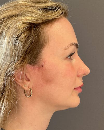 Facelifts / Necklift Before & After Gallery - Patient 252091 - Image 2