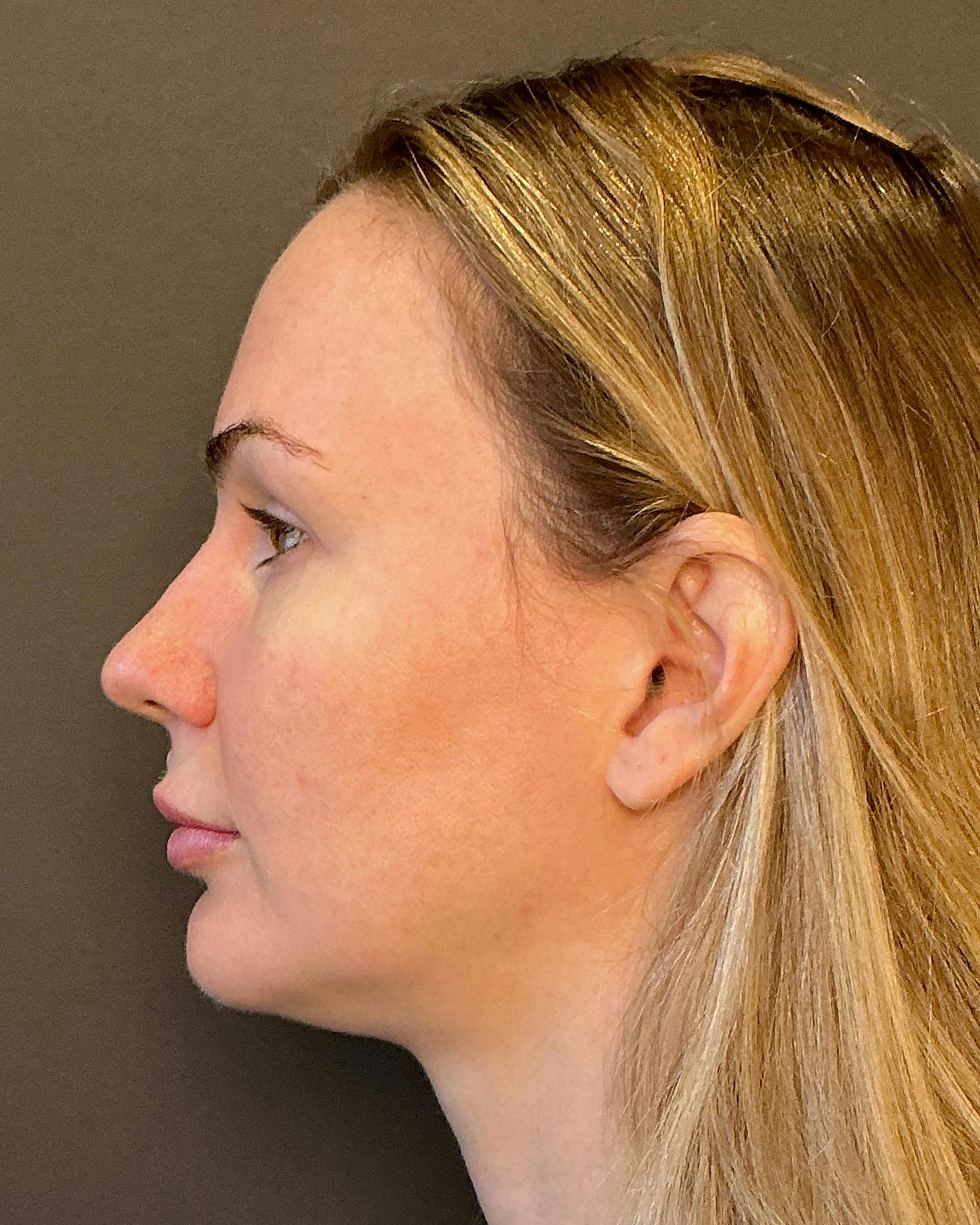 Nanolift Before & After Gallery - Patient 215709 - Image 9