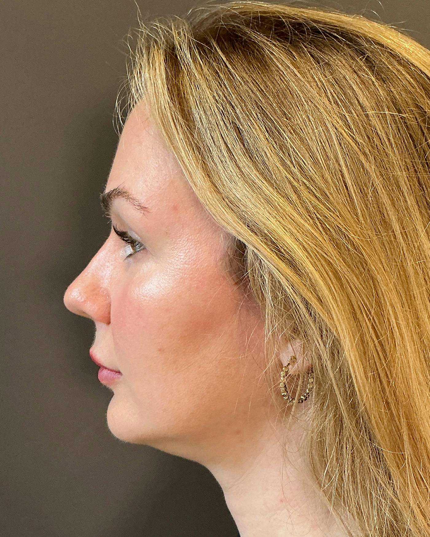 Nanolift Before & After Gallery - Patient 215709 - Image 10