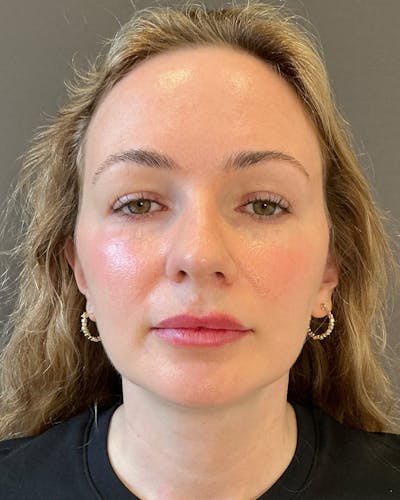 Nanolift Before & After Gallery - Patient 215709 - Image 2