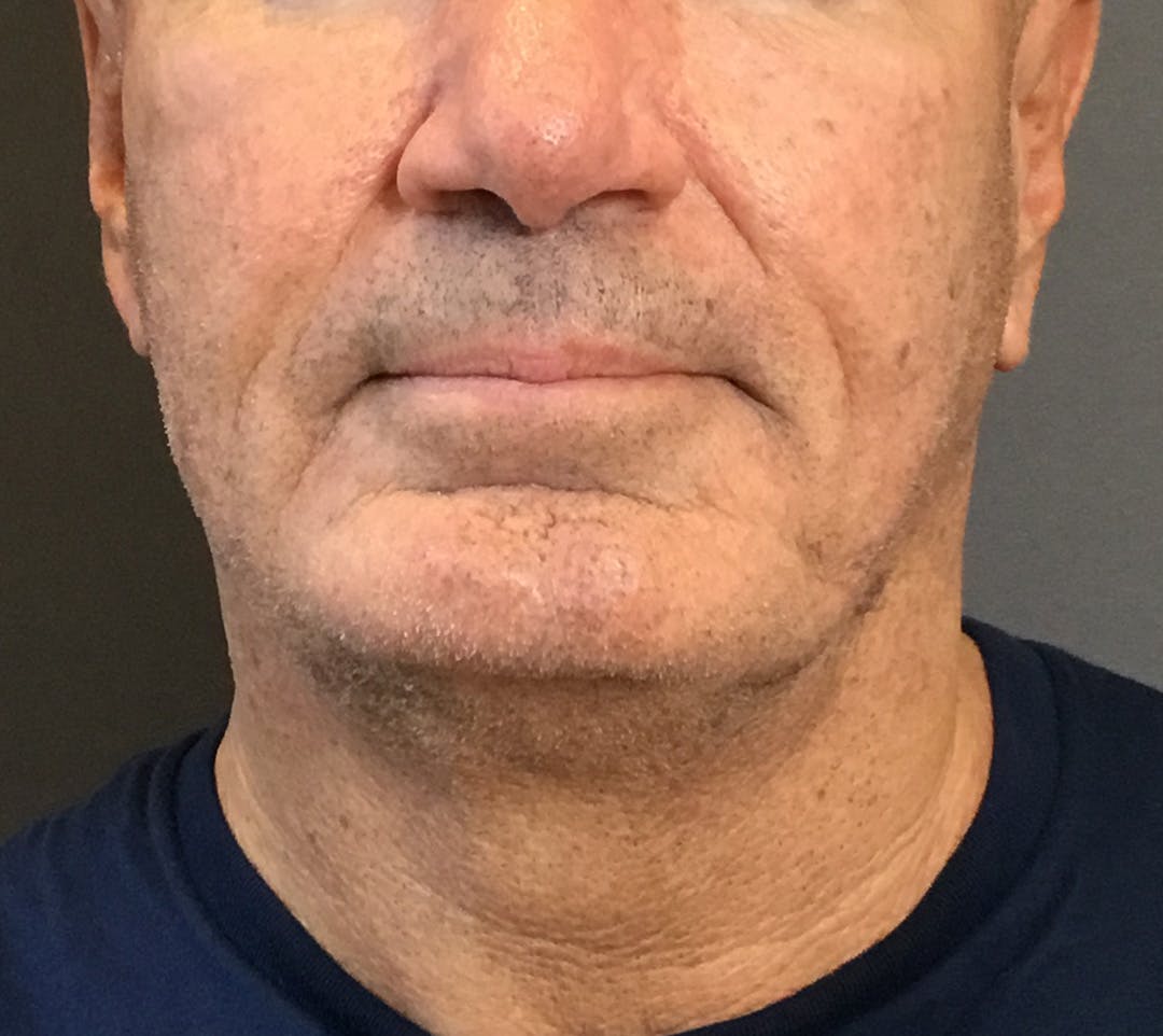 Facelifts / Necklift Before & After Gallery - Patient 710509 - Image 5