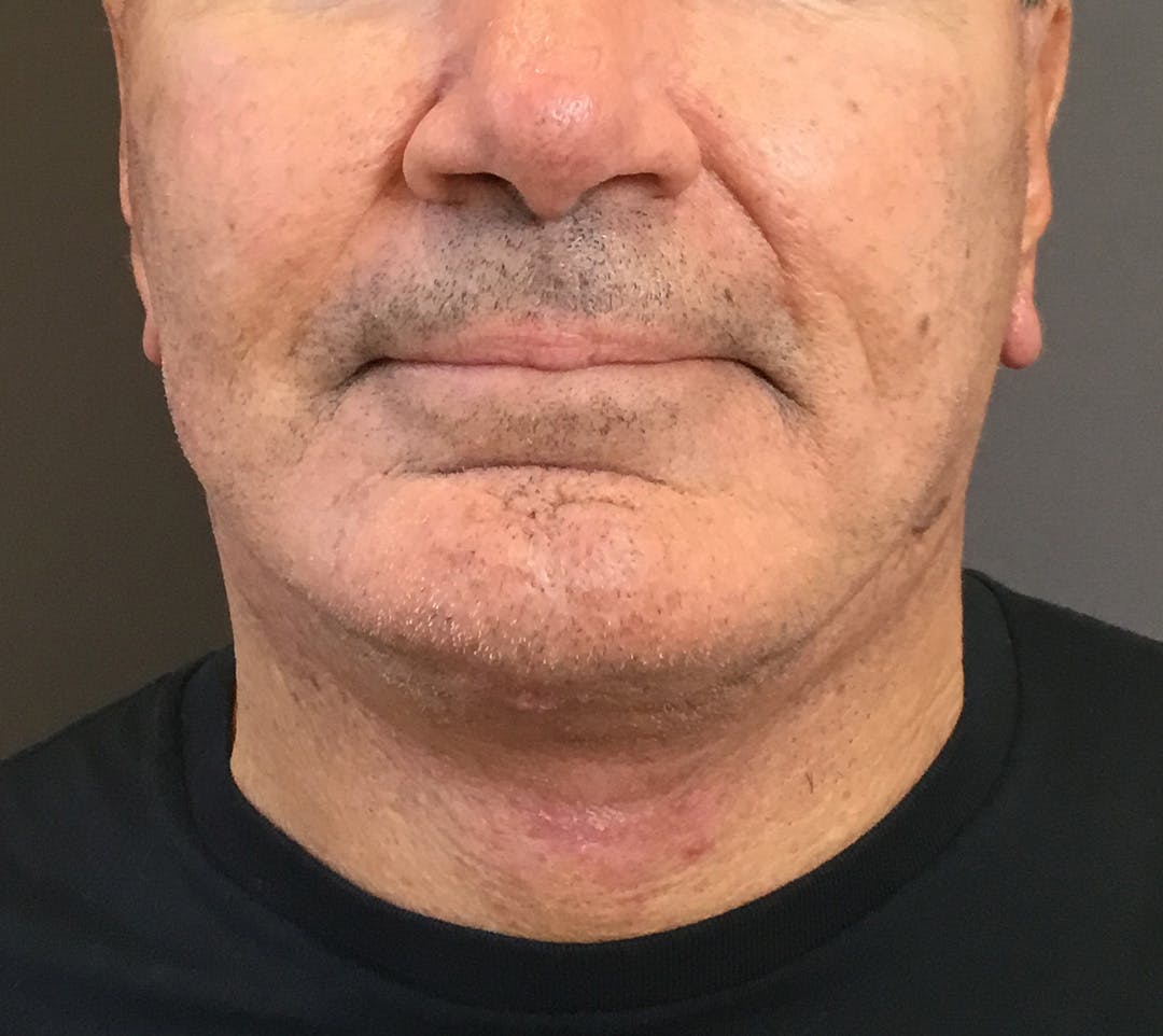 Facelifts / Necklift Before & After Gallery - Patient 710509 - Image 6