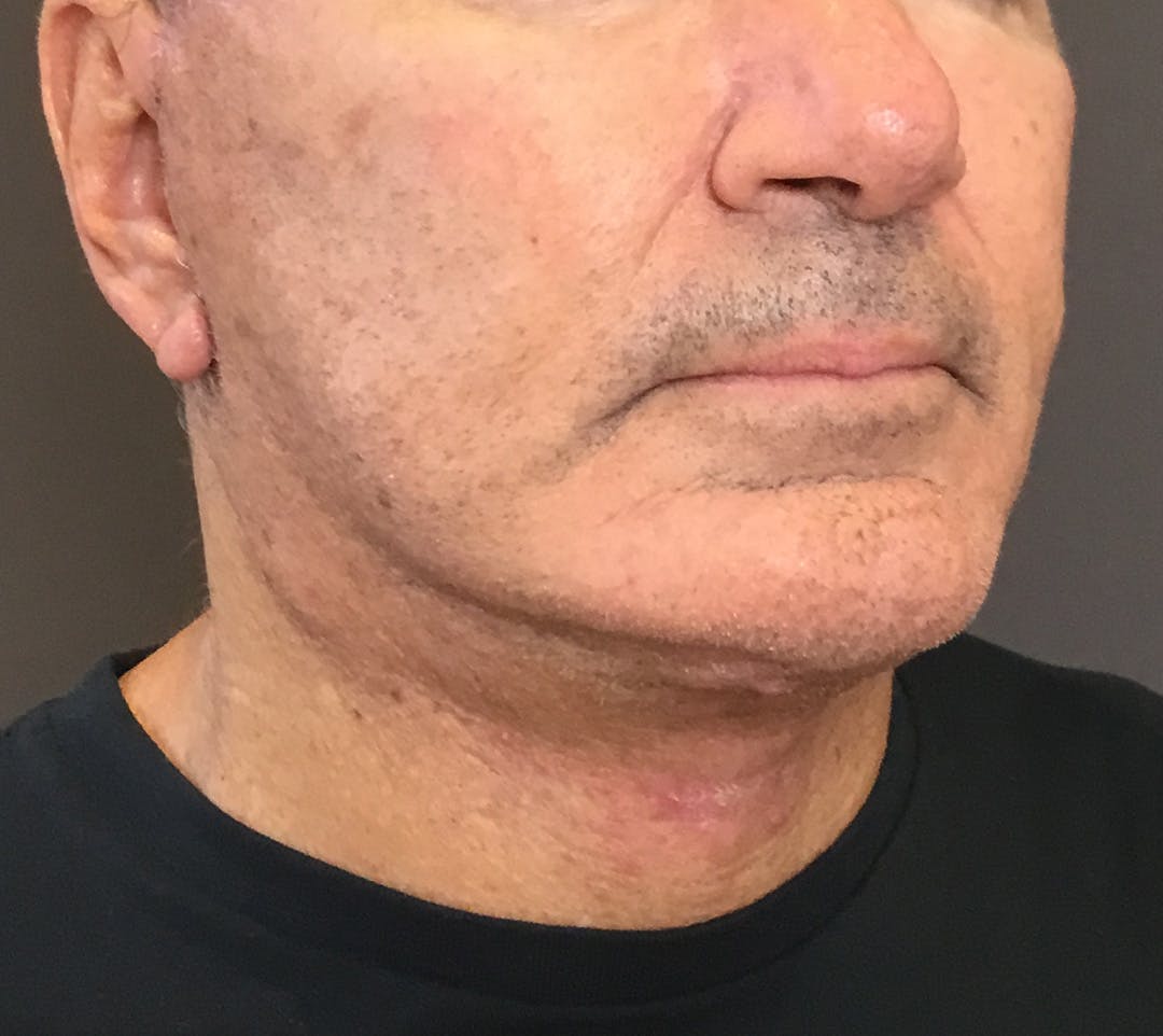 Facelifts / Necklift Before & After Gallery - Patient 710509 - Image 2