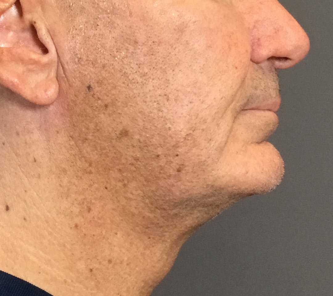 Facelifts / Necklift Before & After Gallery - Patient 710509 - Image 3