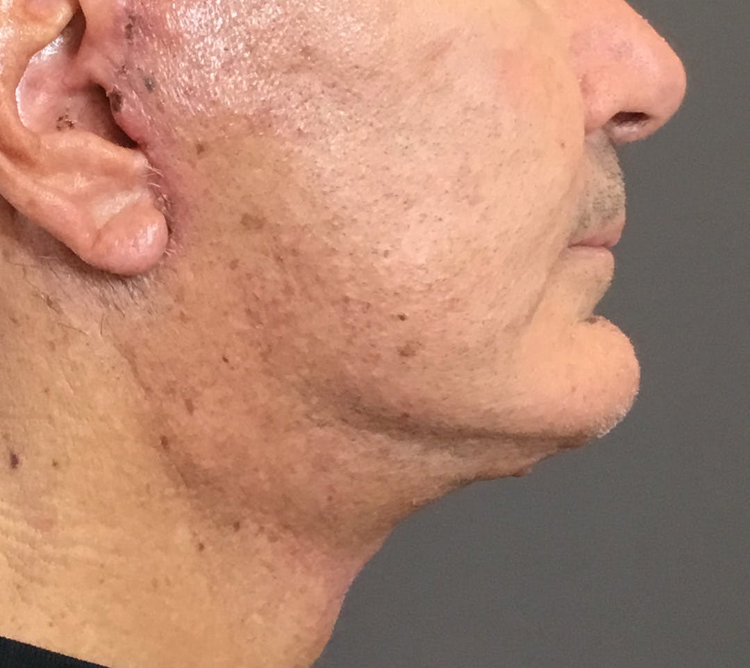 Facelifts / Necklift Before & After Gallery - Patient 710509 - Image 4