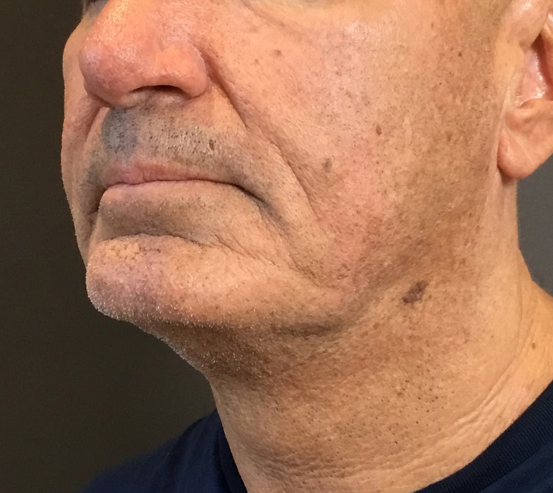 Facelifts / Necklift Before & After Gallery - Patient 710509 - Image 9