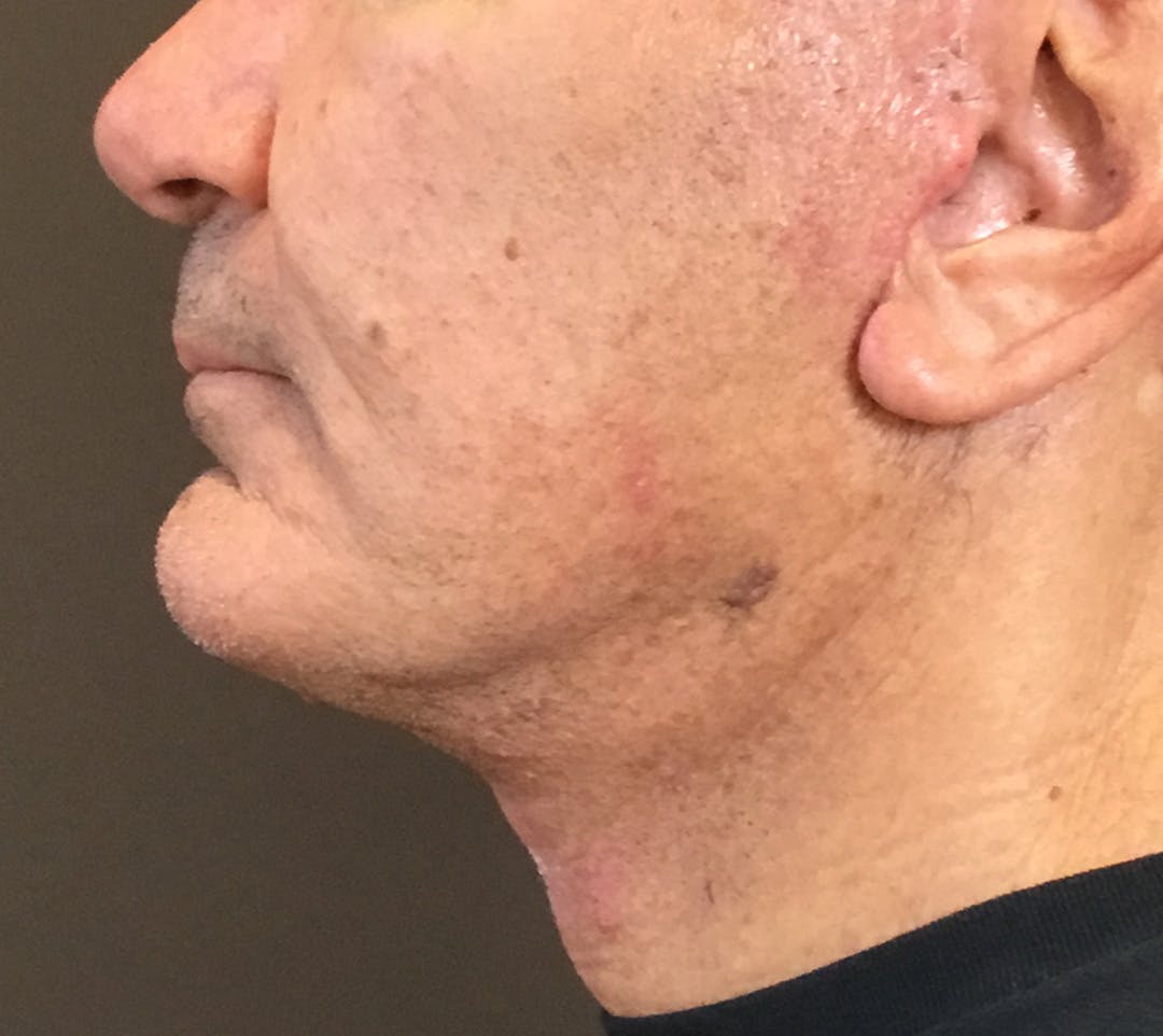 Facelifts / Necklift Before & After Gallery - Patient 710509 - Image 12