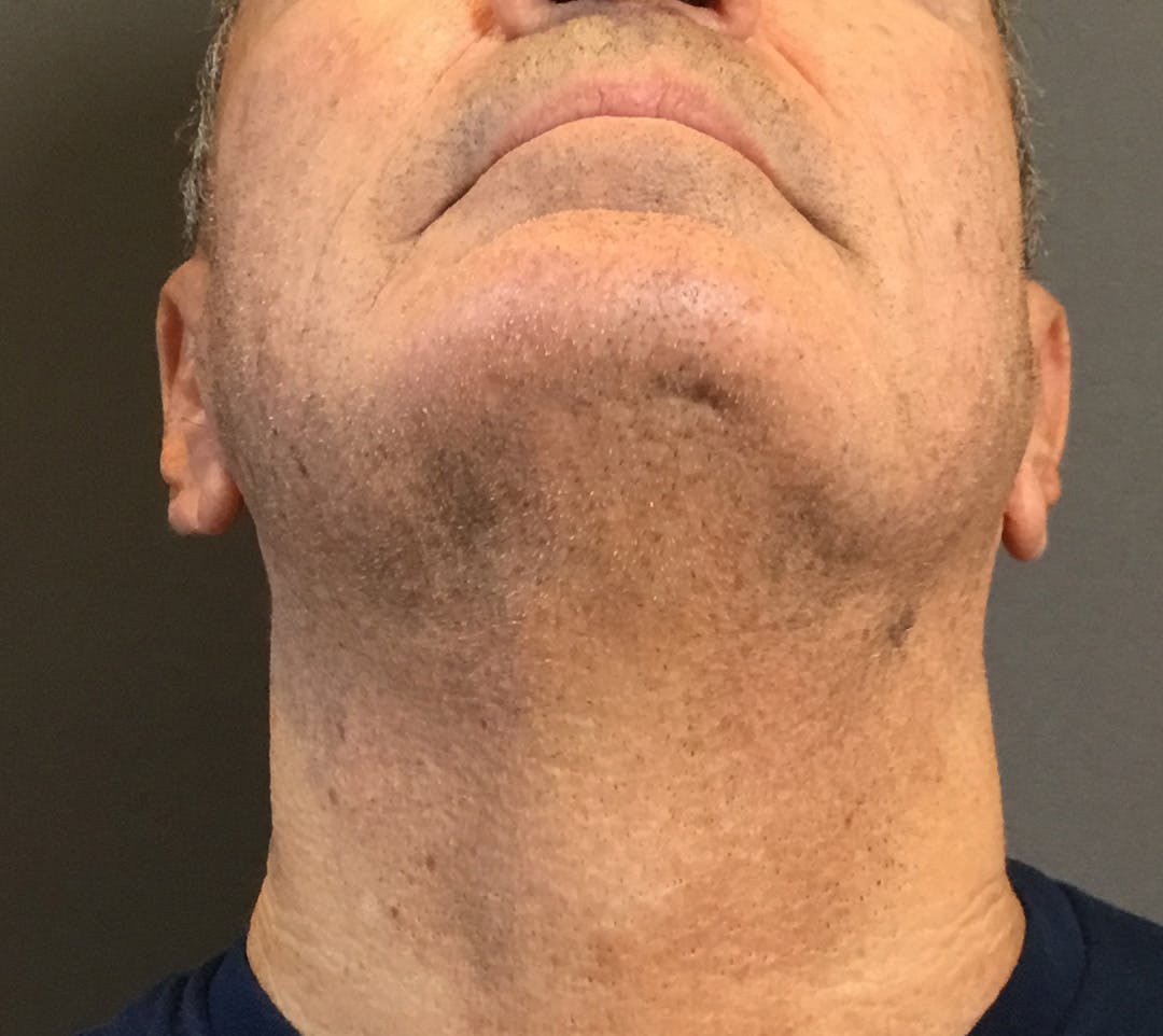 Facelifts / Necklift Before & After Gallery - Patient 710509 - Image 7