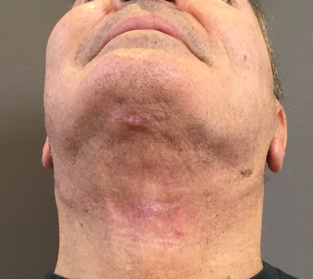 Facelifts / Necklift Before & After Gallery - Patient 710509 - Image 8