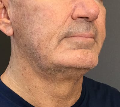 Facelifts / Necklift Before & After Gallery - Patient 710509 - Image 1