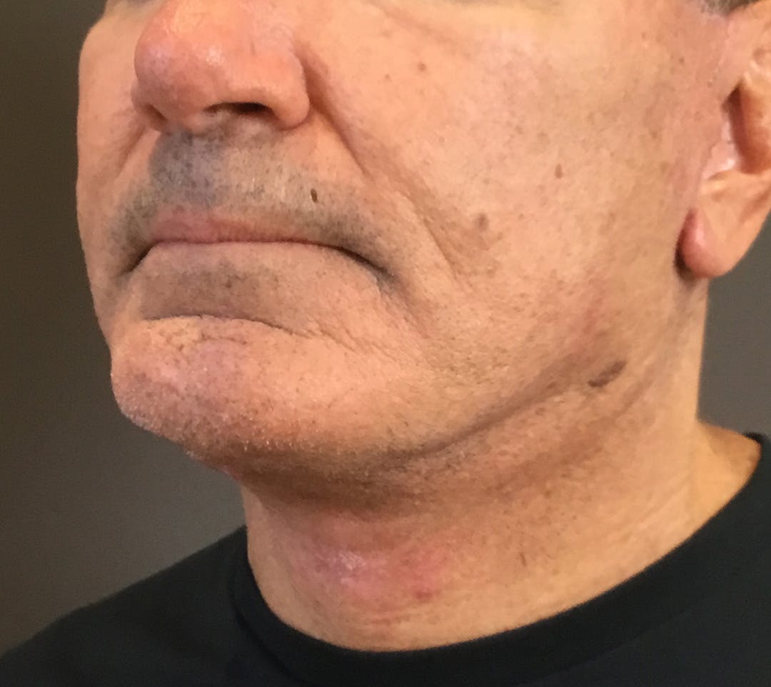 Facelifts / Necklift Before & After Gallery - Patient 710509 - Image 10