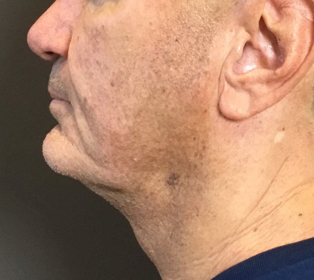 Facelifts / Necklift Before & After Gallery - Patient 710509 - Image 11
