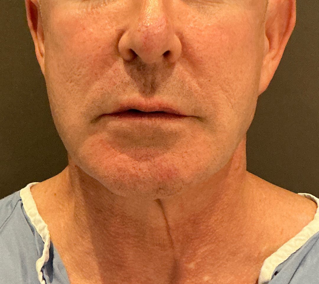 Facelifts / Necklift Before & After Gallery - Patient 414088 - Image 5