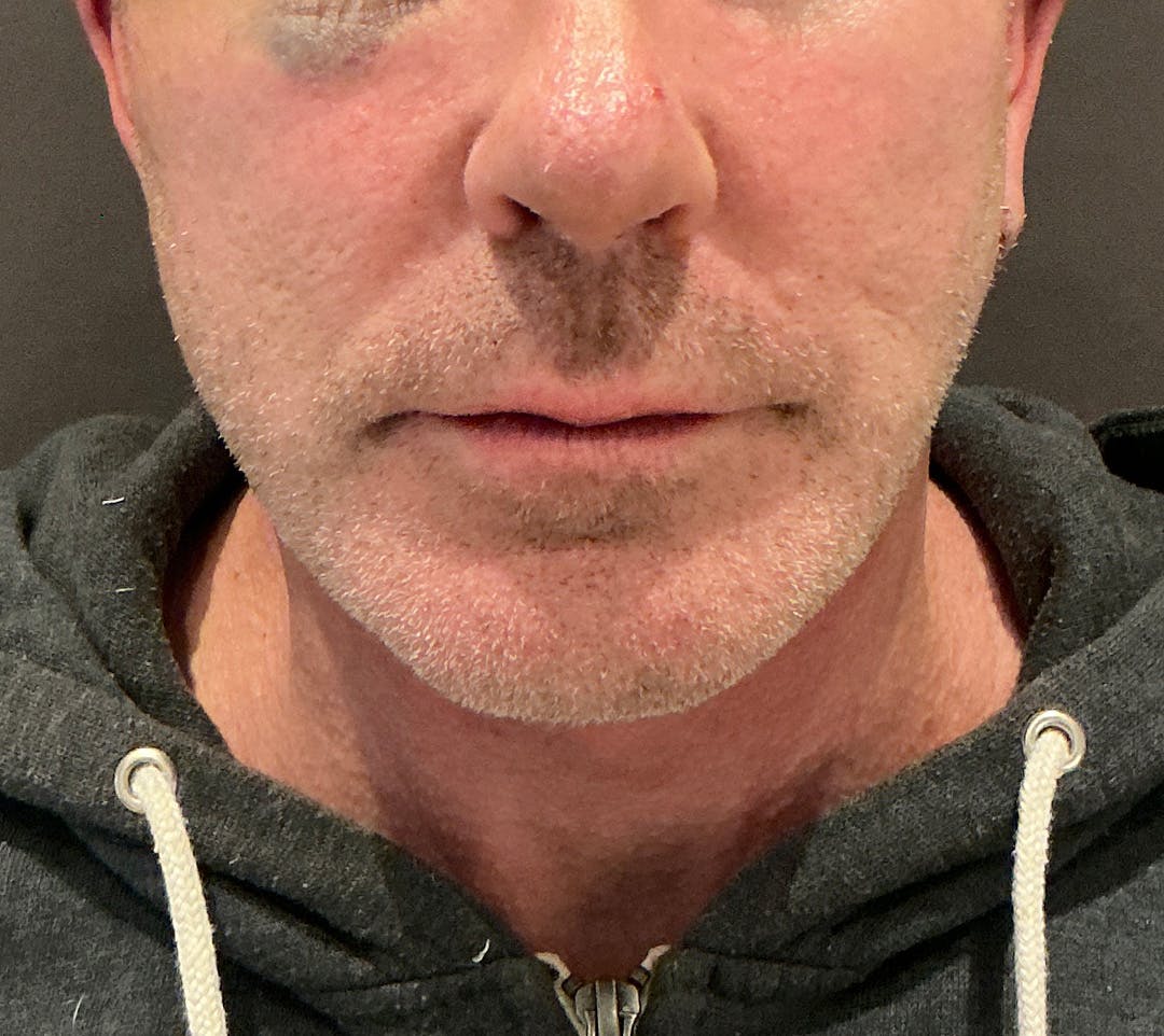 Facelifts / Necklift Before & After Gallery - Patient 414088 - Image 6