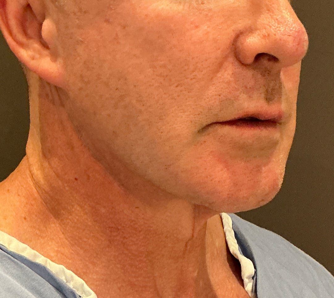 Facelifts / Necklift Before & After Gallery - Patient 414088 - Image 1