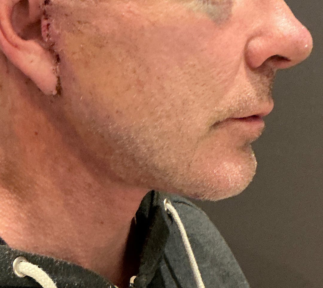 Facelifts / Necklift Before & After Gallery - Patient 414088 - Image 2