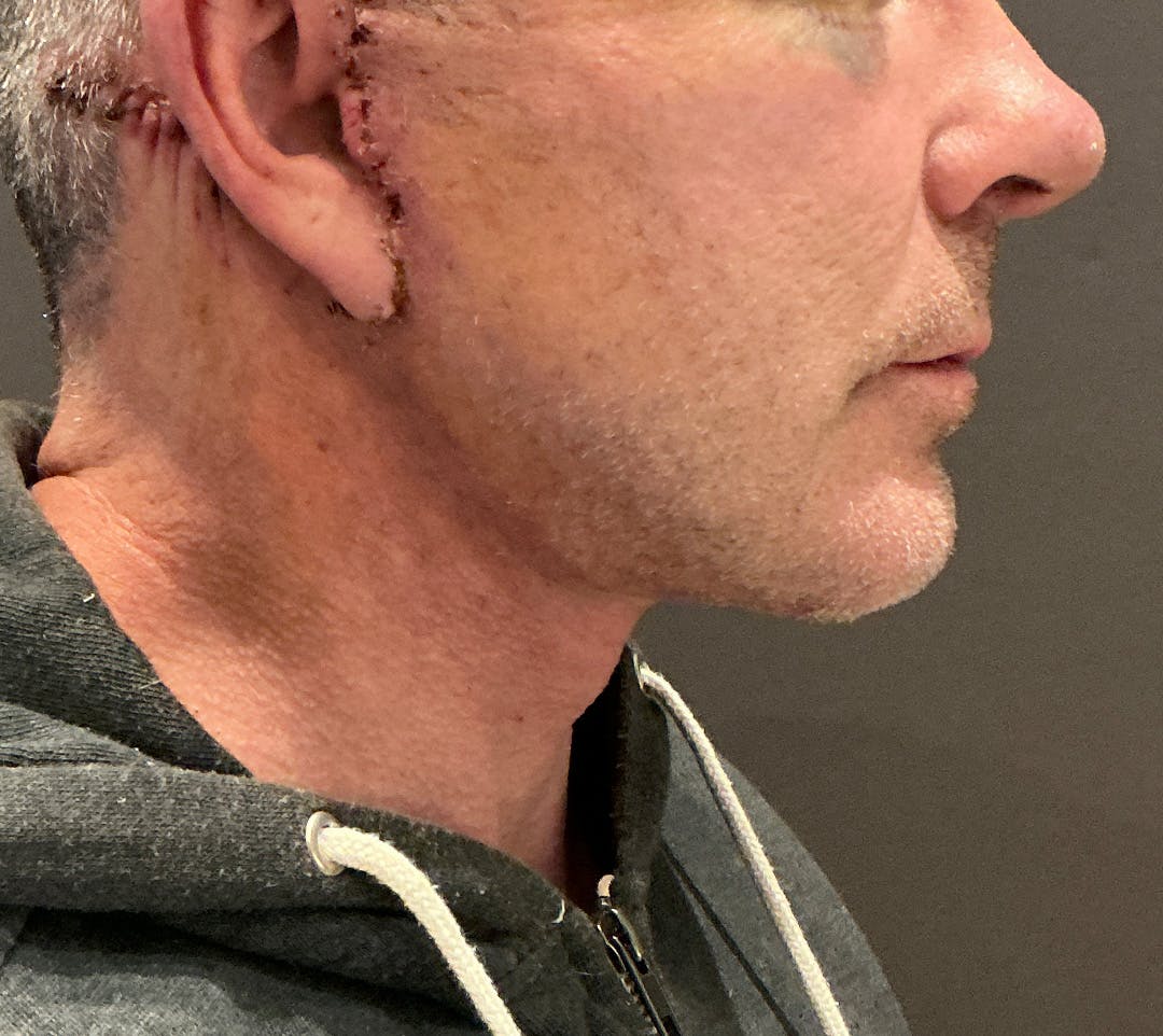 Facelifts / Necklift Before & After Gallery - Patient 414088 - Image 4