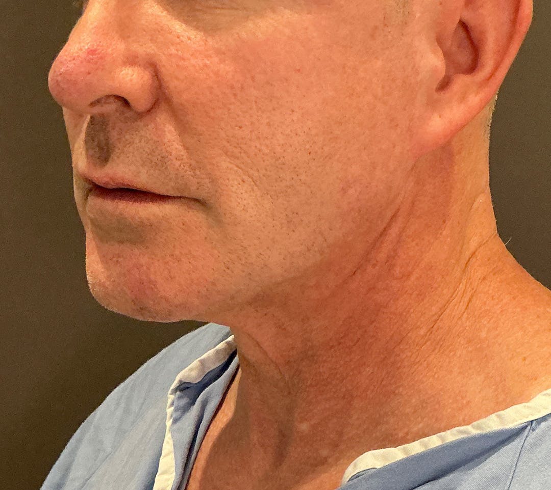 Facelifts / Necklift Before & After Gallery - Patient 414088 - Image 9