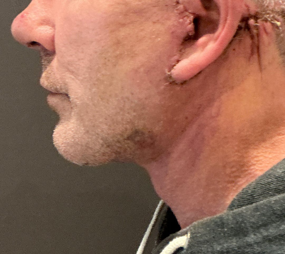 Facelifts / Necklift Before & After Gallery - Patient 414088 - Image 12
