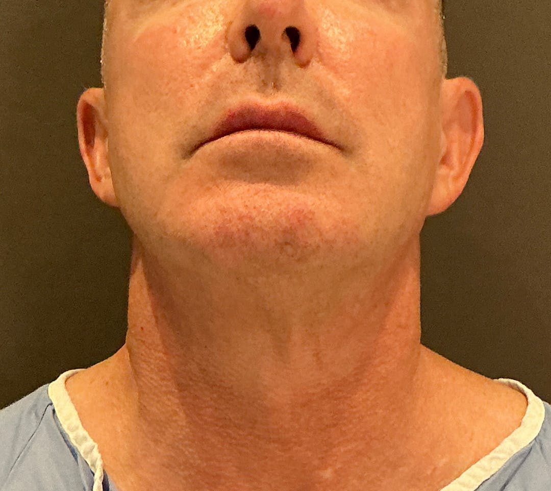 Facelifts / Necklift Before & After Gallery - Patient 414088 - Image 7