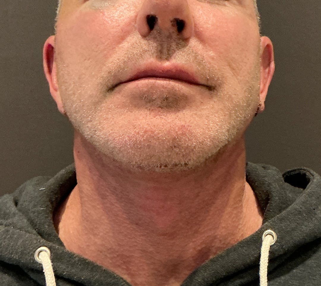 Facelifts / Necklift Before & After Gallery - Patient 414088 - Image 8