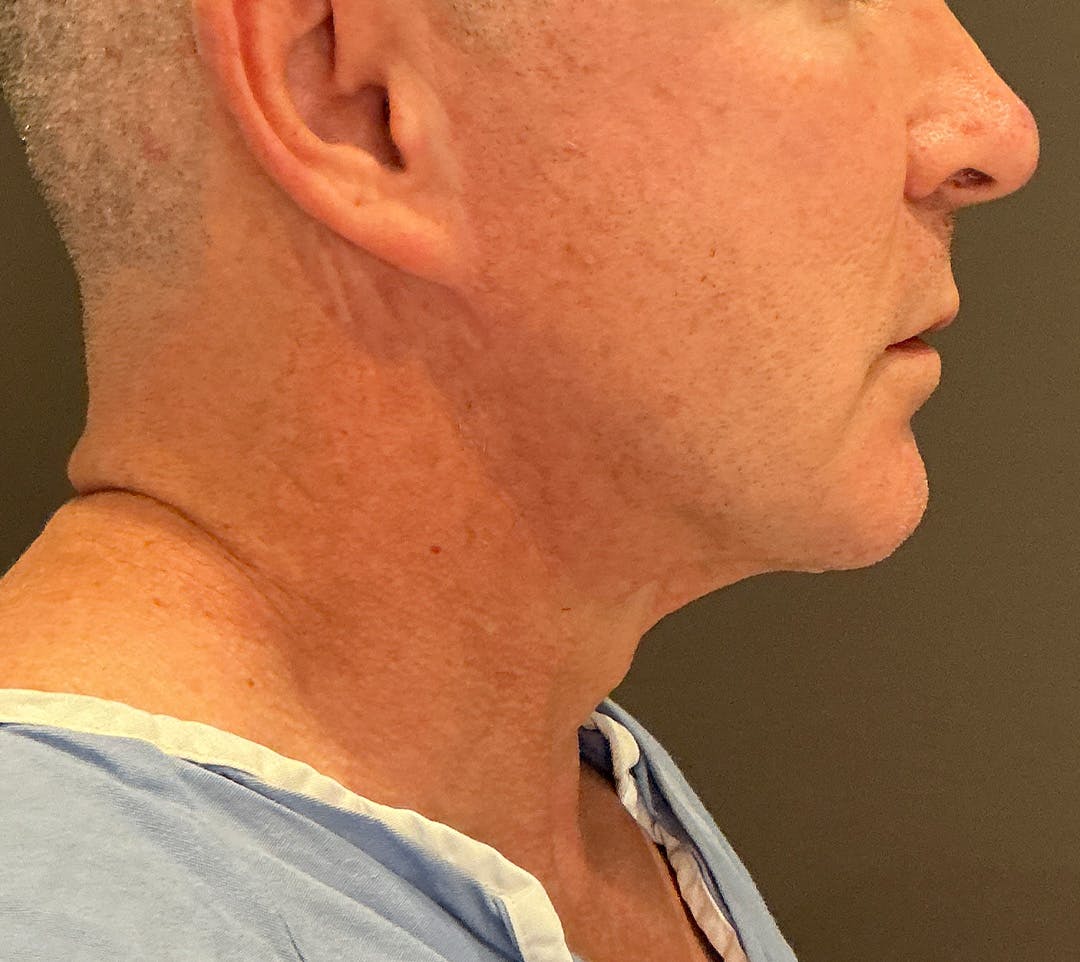 Facelifts / Necklift Before & After Gallery - Patient 414088 - Image 3
