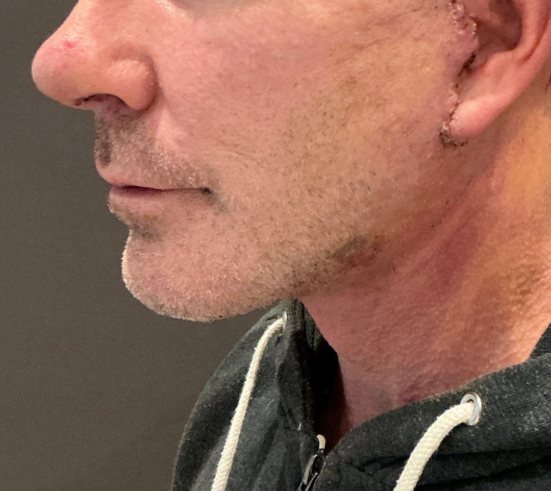 Facelifts / Necklift Before & After Gallery - Patient 414088 - Image 10