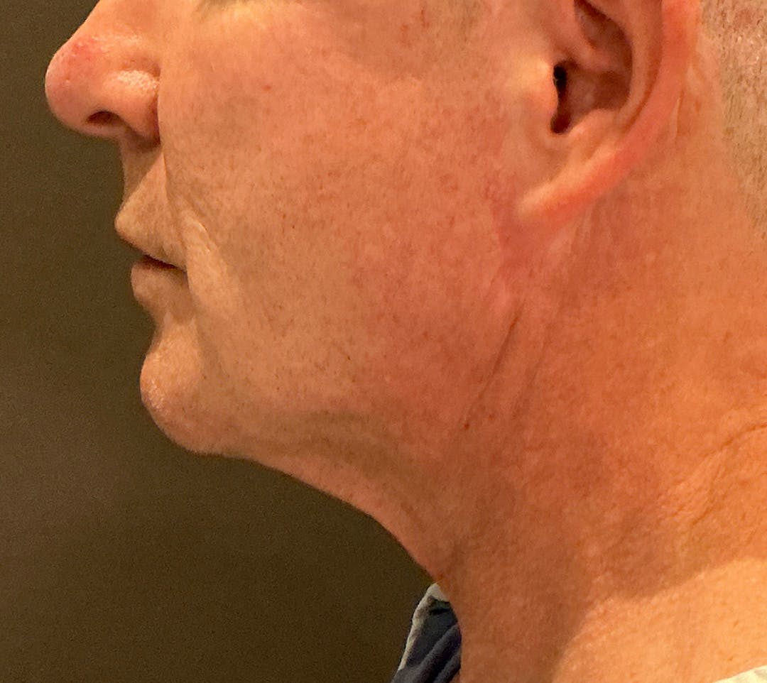 Facelifts / Necklift Before & After Gallery - Patient 414088 - Image 11