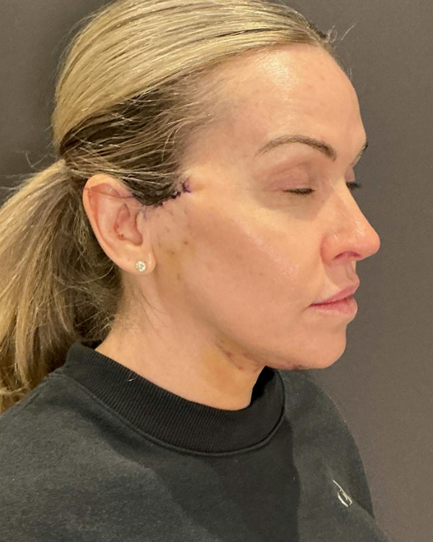 Nanolift Before & After Gallery - Patient 385079 - Image 2