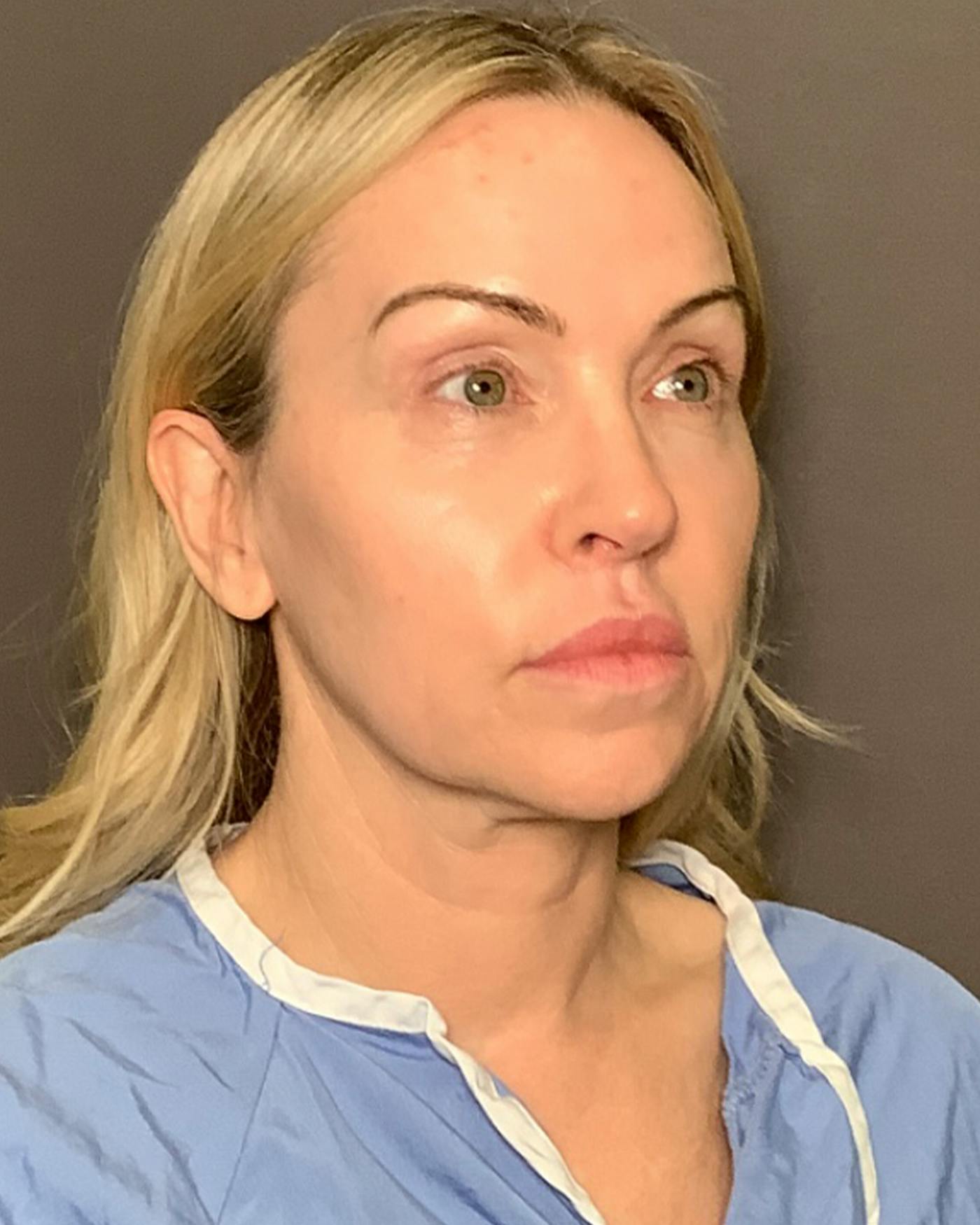 Nanolift Before & After Gallery - Patient 385079 - Image 1