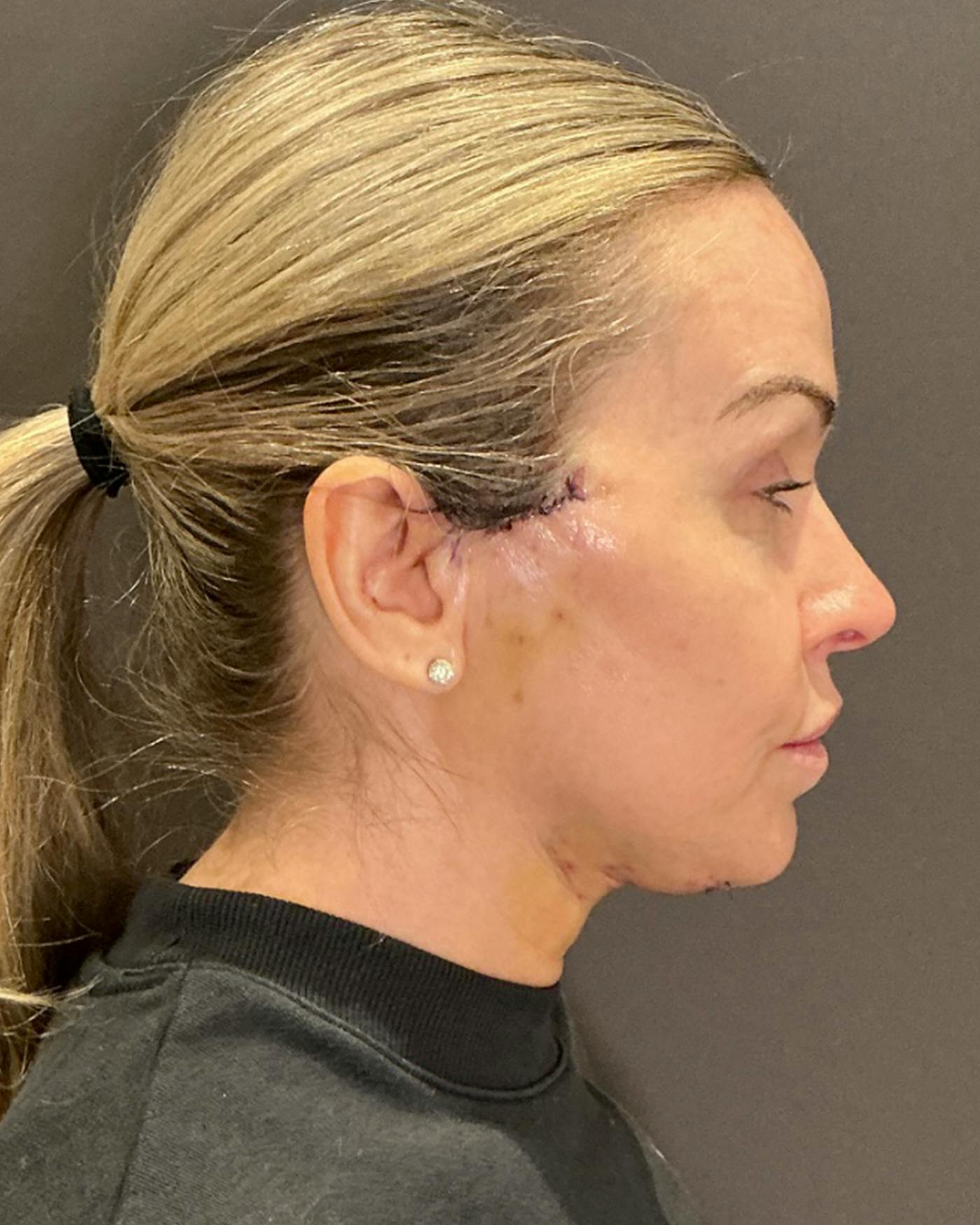 Nanolift Before & After Gallery - Patient 385079 - Image 4