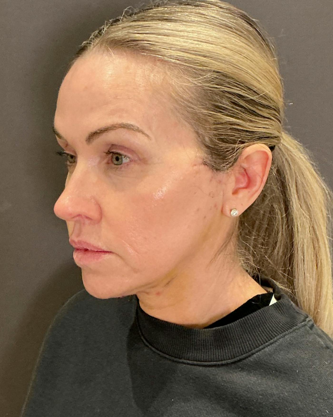 Nanolift Before & After Gallery - Patient 385079 - Image 8