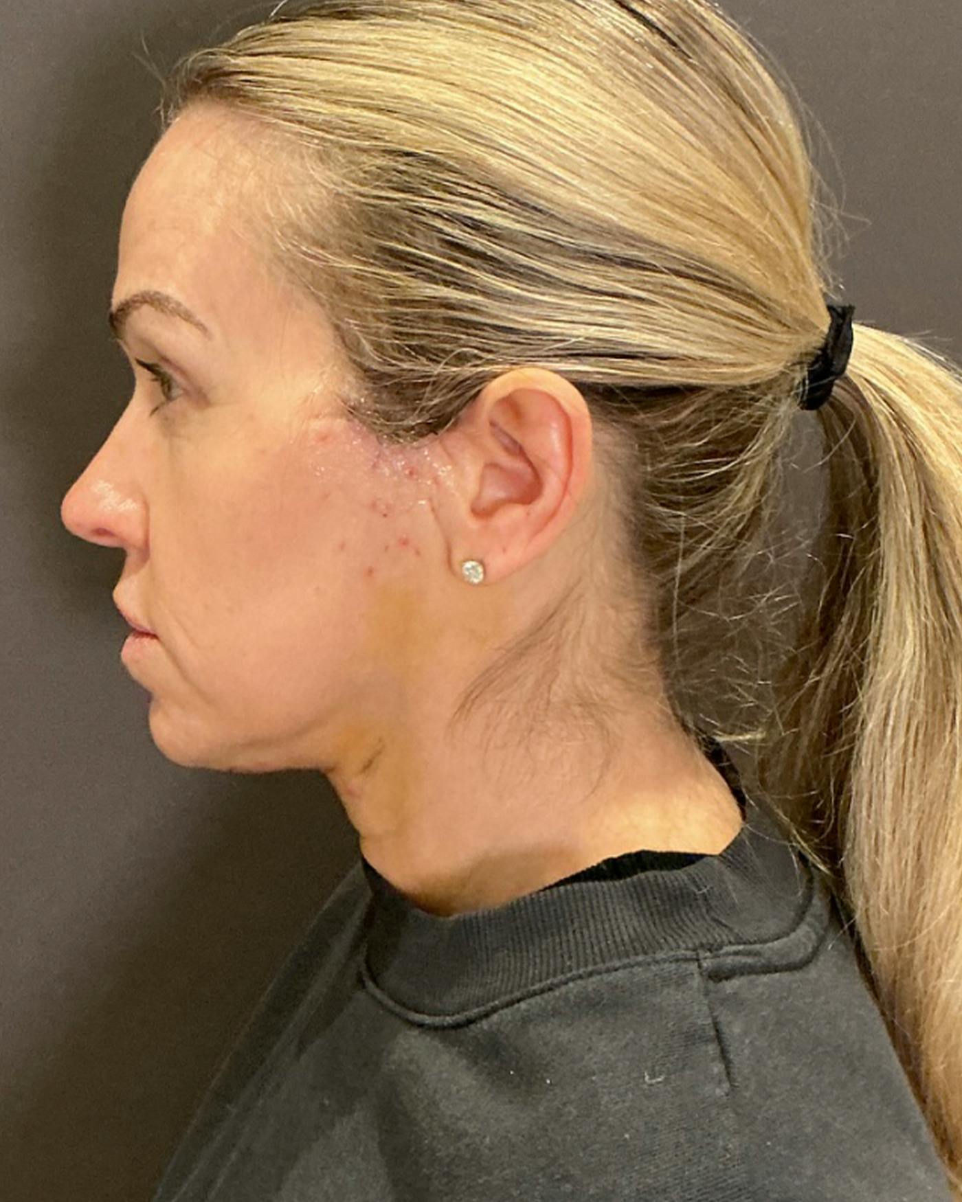 Nanolift Before & After Gallery - Patient 385079 - Image 10