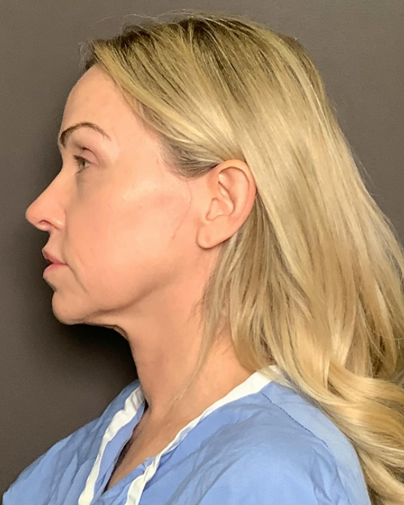 Nanolift Before & After Gallery - Patient 385079 - Image 9