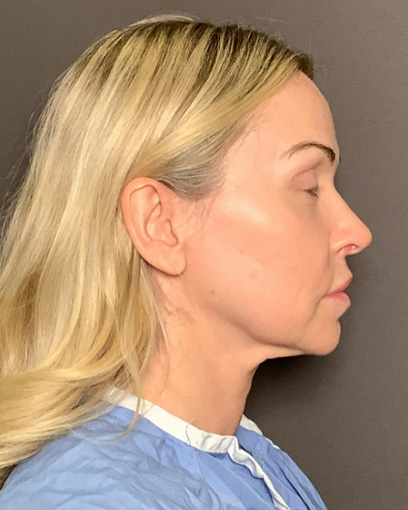 Nanolift Before & After Gallery - Patient 385079 - Image 3