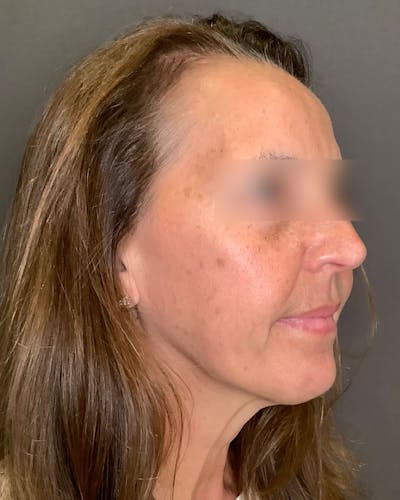 Brow Lift Before & After Gallery - Patient 120517 - Image 1