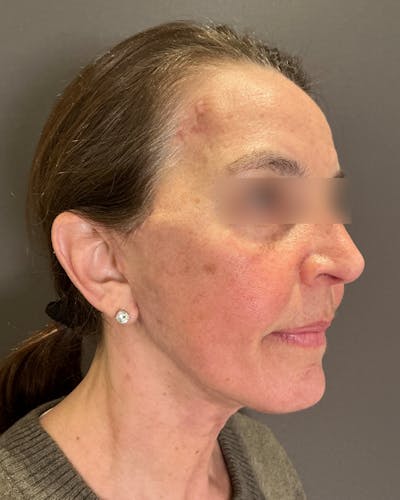 Brow Lift Before & After Gallery - Patient 120517 - Image 2