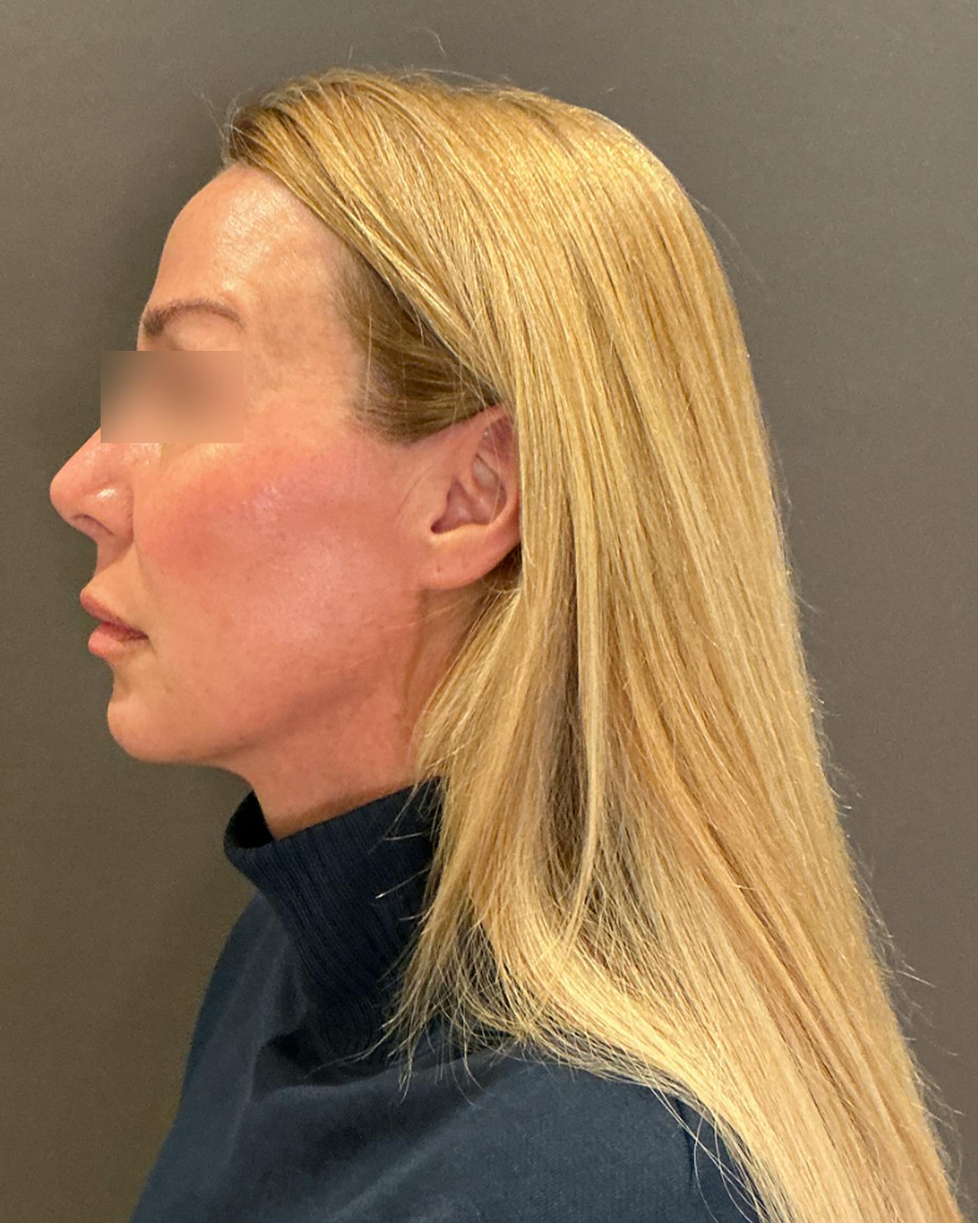 Eyelid Surgery Before & After Gallery - Patient 268821 - Image 7
