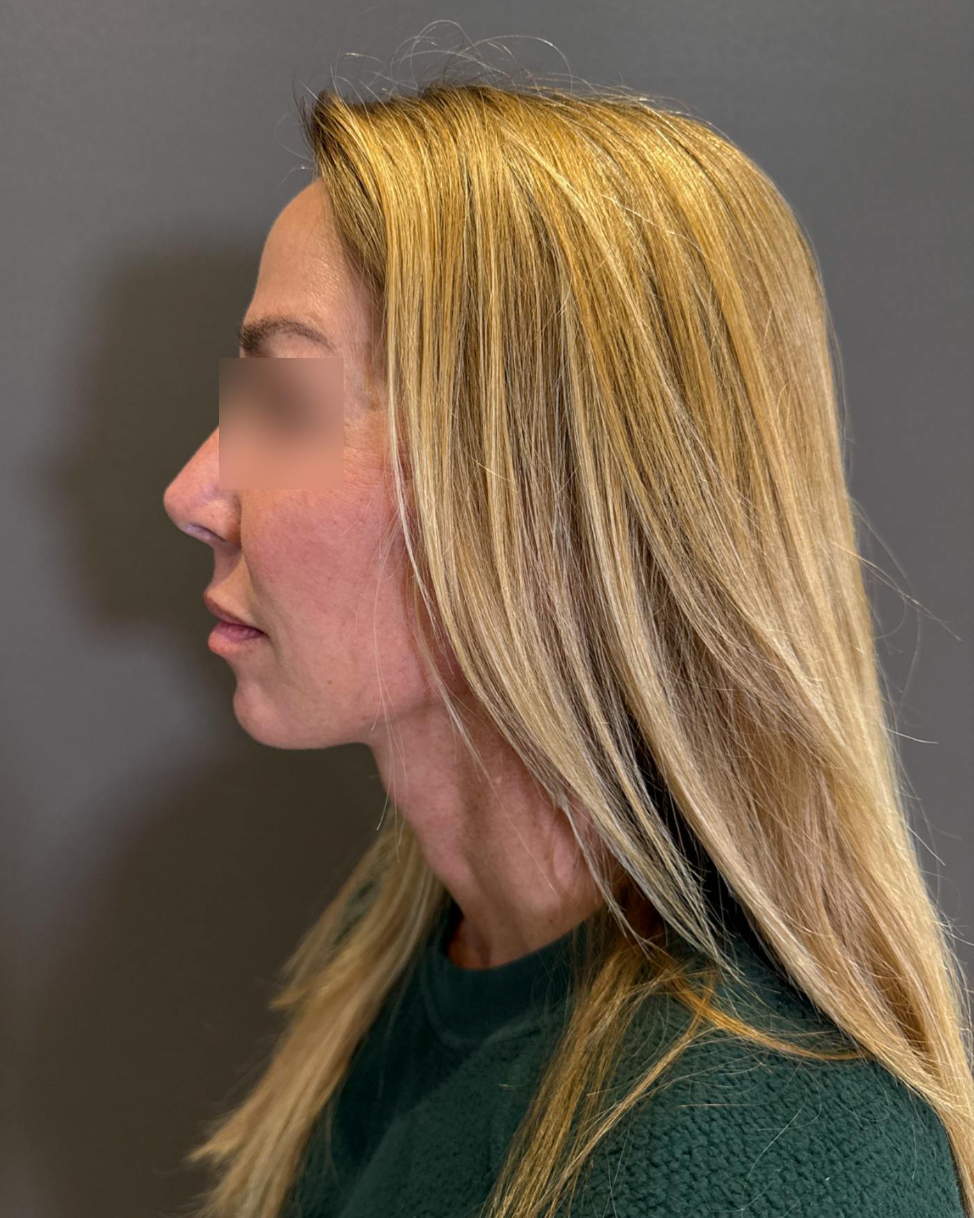 Eyelid Surgery Before & After Gallery - Patient 268821 - Image 8