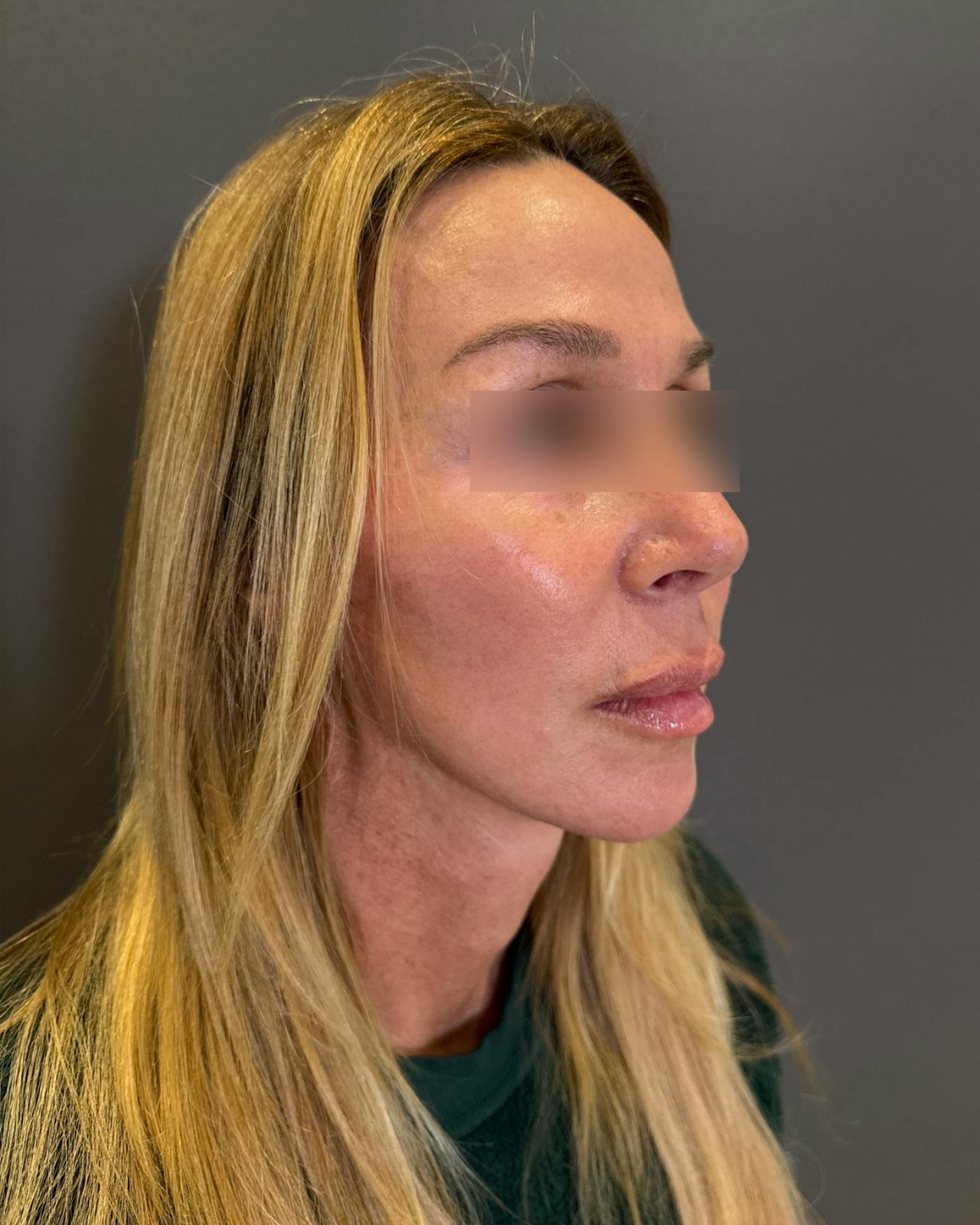 Eyelid Surgery Before & After Gallery - Patient 268821 - Image 2