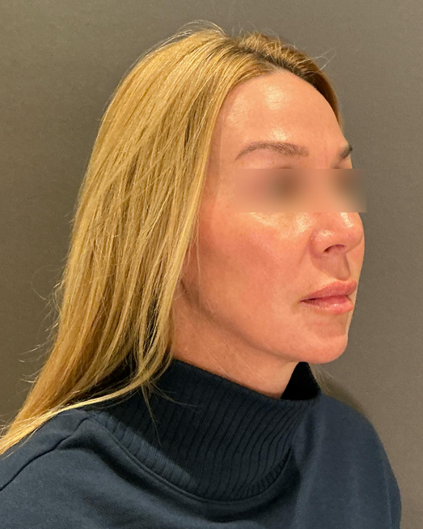 Eyelid Surgery Before & After Gallery - Patient 268821 - Image 1