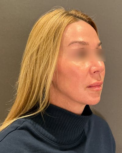 Eyelid Surgery Before & After Gallery - Patient 268821 - Image 1