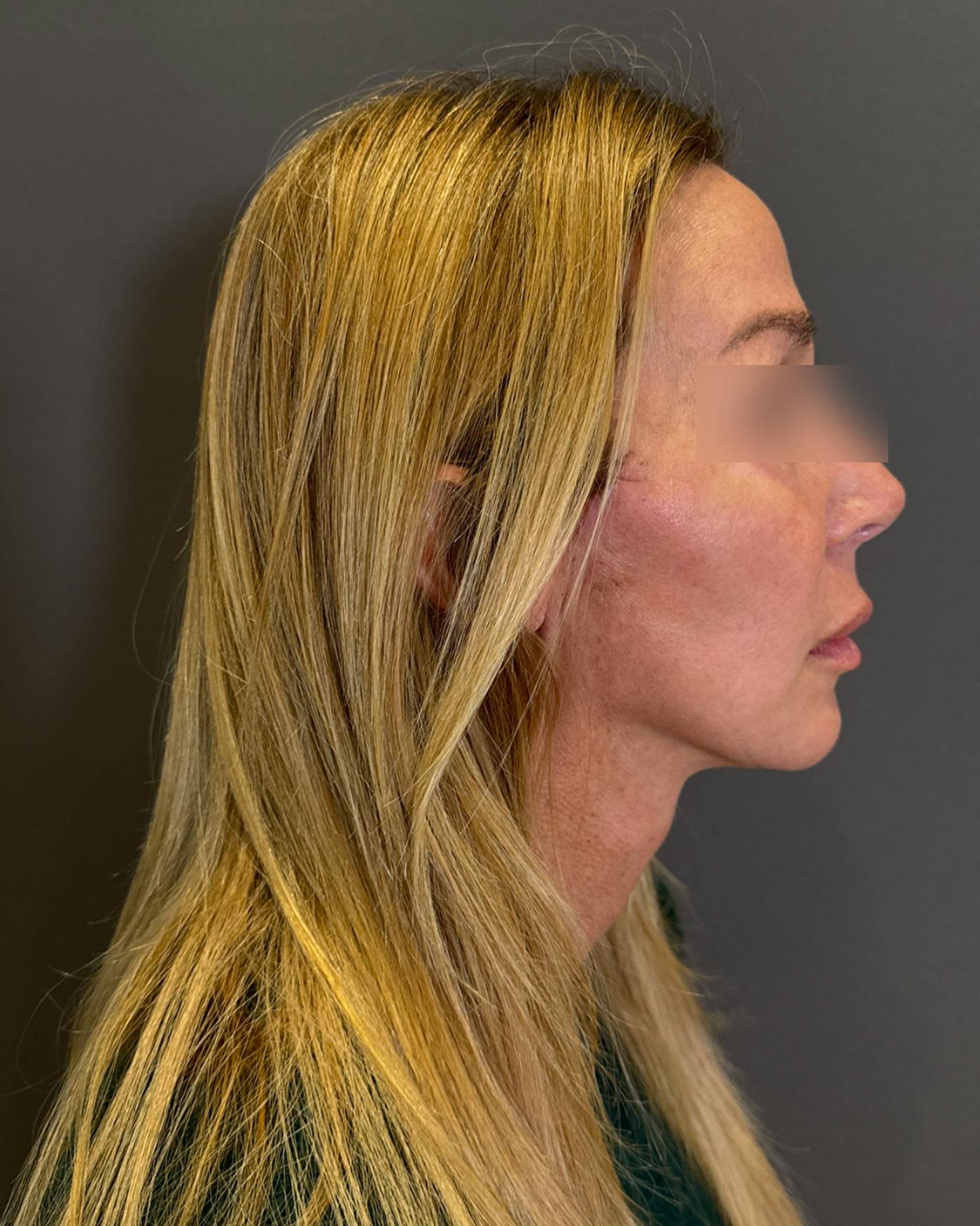 Eyelid Surgery Before & After Gallery - Patient 268821 - Image 4
