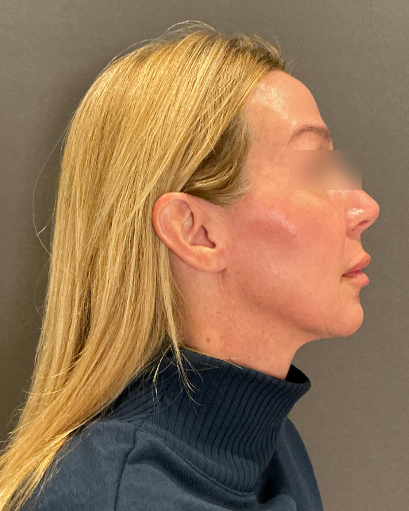 Eyelid Surgery Before & After Gallery - Patient 268821 - Image 3